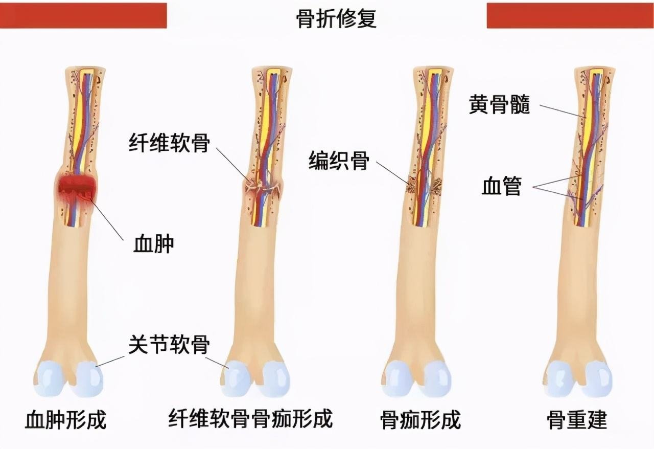 骨折愈合的过程分为血肿炎症机化期,原始骨痂形成期以及骨痂塑型期,这