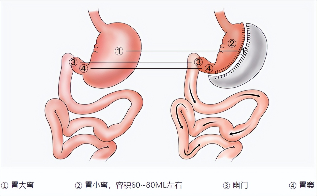 袖狀胃手術以縮小胃容積為主,距幽門2~6cm處作為胃大彎切割起點,向上