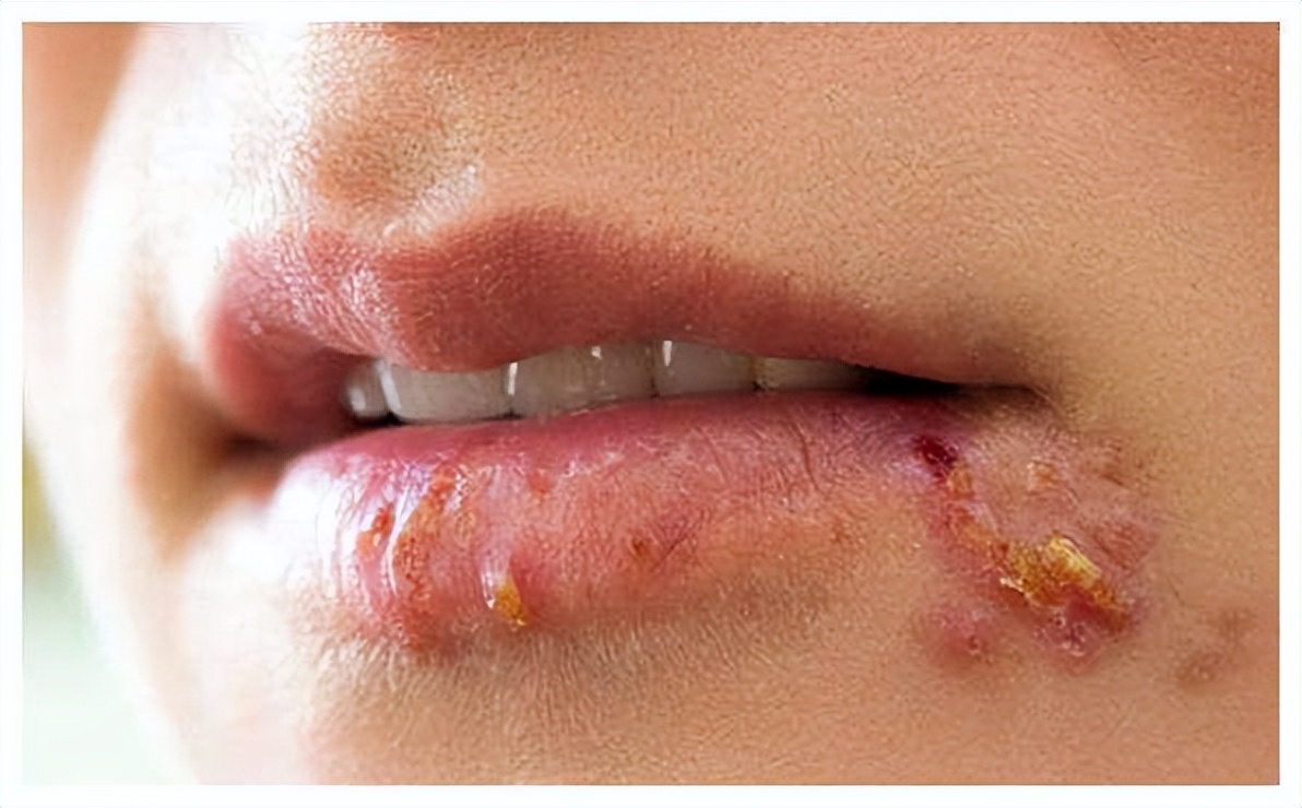 嘴巴周围时不时出现"几个水泡",或许不是"上火",应注意