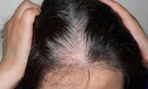人體缺什麼“維生素”會長白髮？ 怎麼防止白髮出現？ 看後漲知識了
