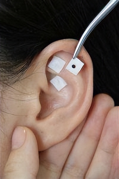 仁医科普| 菊花疼不一定是痔疮，警惕肛周脓肿！