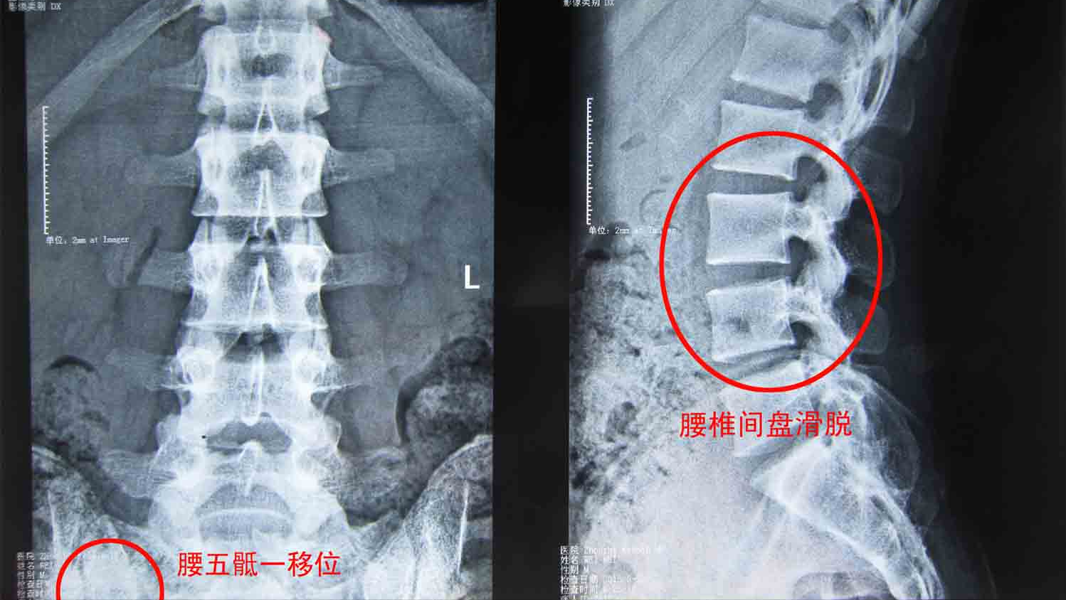 腰椎滑脫和腰椎間盤突出症有什麼關係?