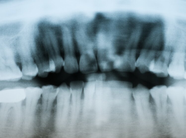 牙齿上的“小石头”，怎么去除好得快？真正有用的方法是这3个