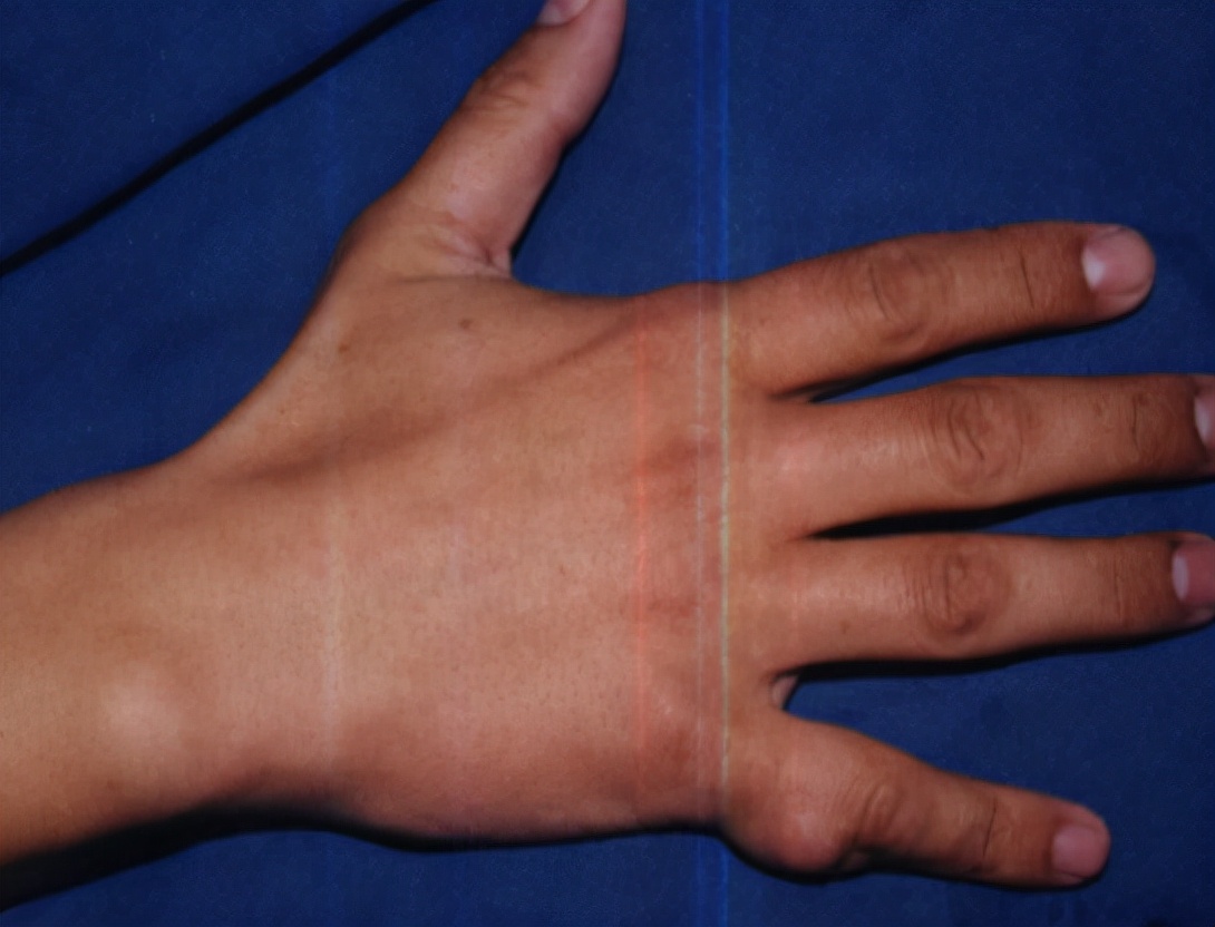 腱鞘炎到底是怎么来的?为啥女性易受其困扰?该如何治疗?