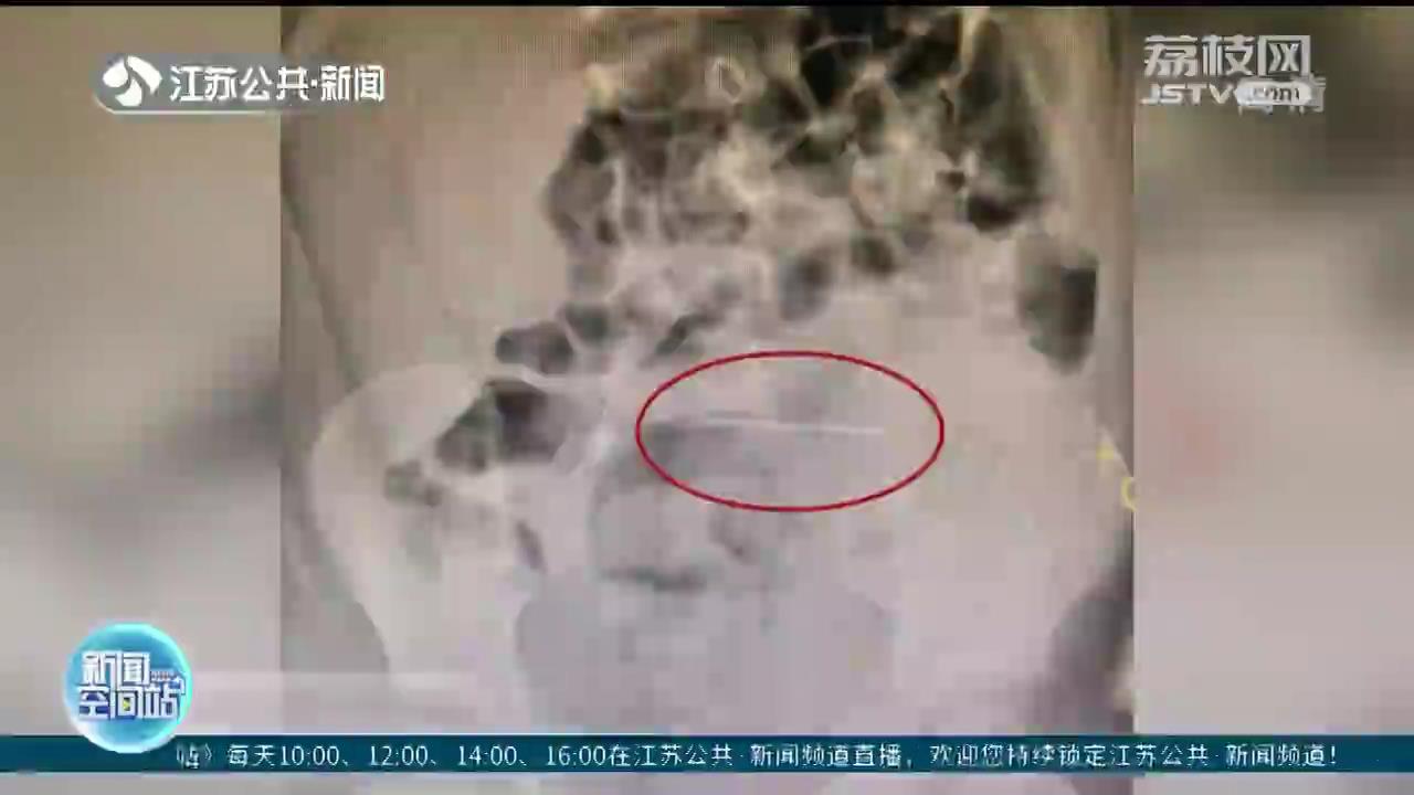 命悬一线！淮安2岁男童吞下3.5厘米钢针 一端扎在肠壁上