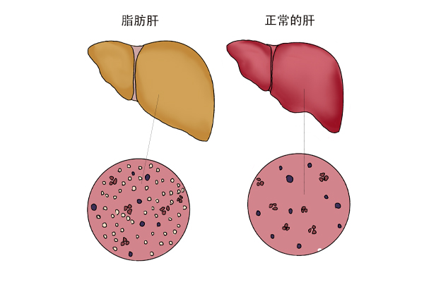 为什么脂肪肝发病率越来越高？避开4个诱因，对肝脏有好处