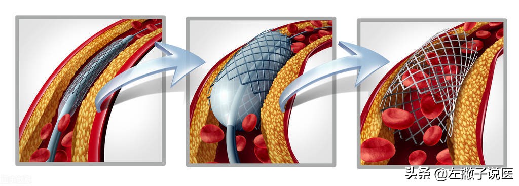 喝醋疏通血管?5个"疏通血管"的方法害人不浅
