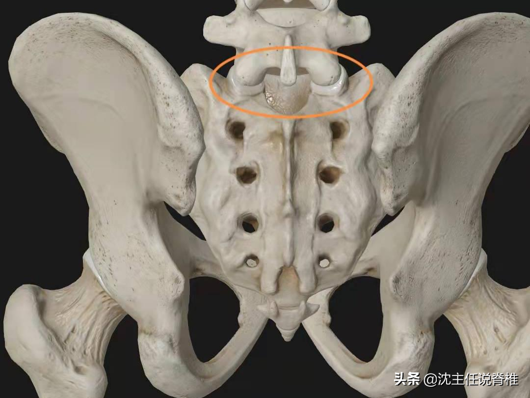 女性腰椎间盘突出图片(腰臀或下肢痛) - 赤虎壹号