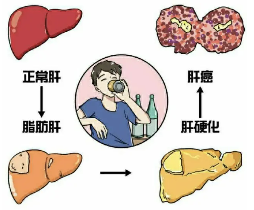 脂肪肝！滚蛋吧