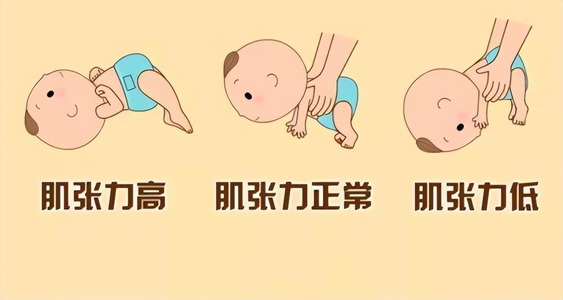 出生2天宝宝能抬头被疑肌张力高，怎么回事？肌张力高怎么判断