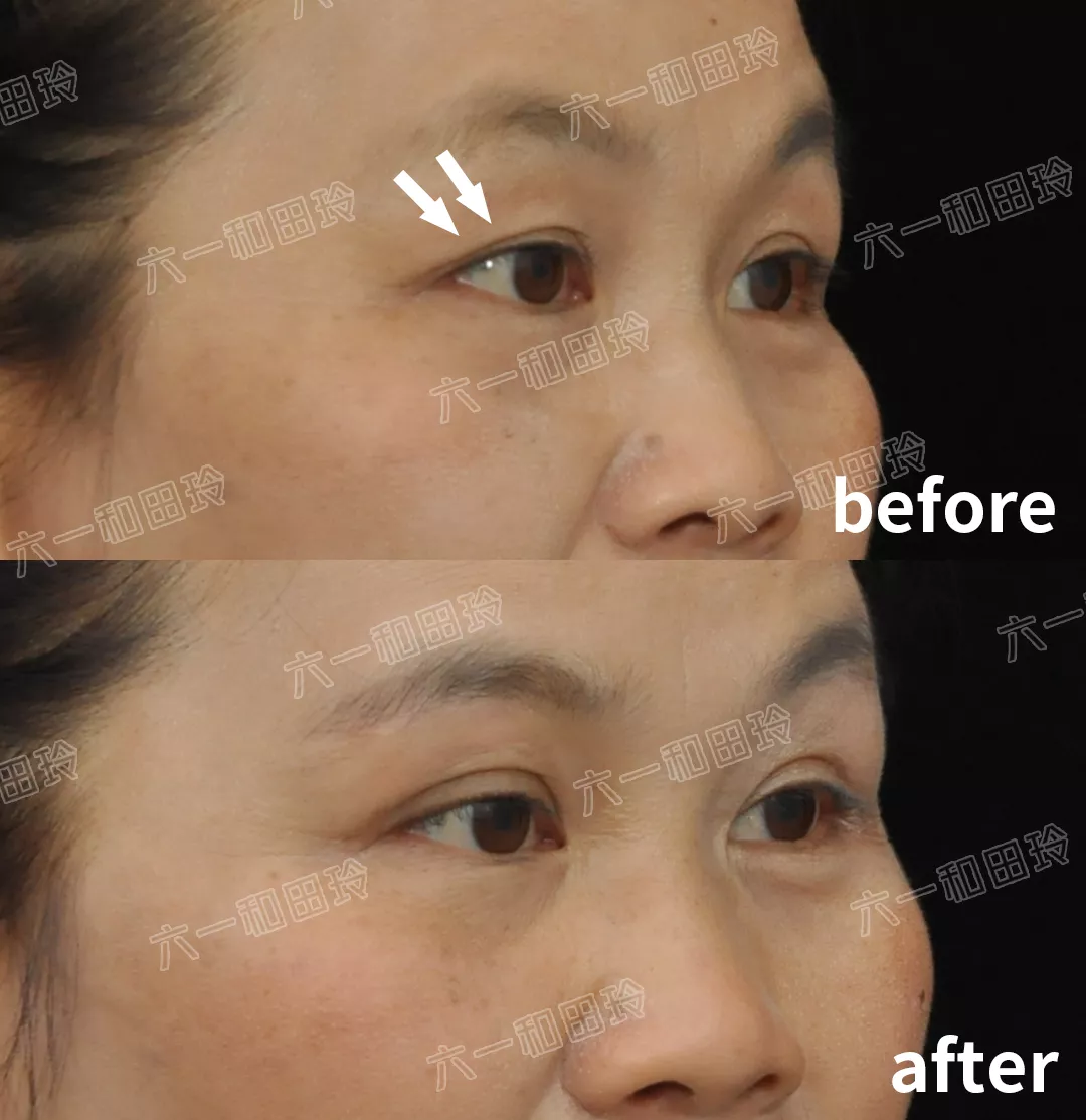 过年给妈妈最好的礼物，就是隐形眉眼提升