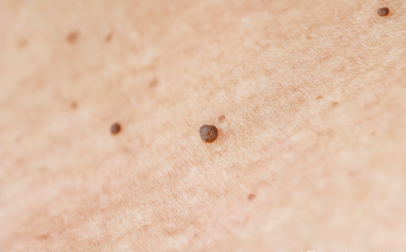 疣图片初期图片(脖子和腋下的) - 赤虎壹号