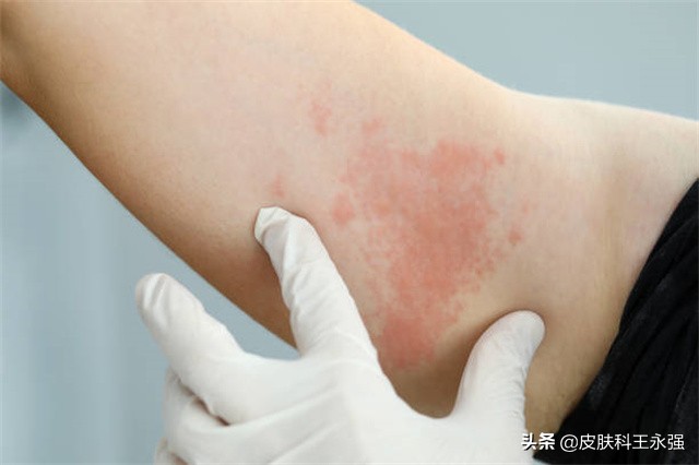 有一种剧痛叫"带状疱疹",提醒:3类人尤其要当心,及时就医