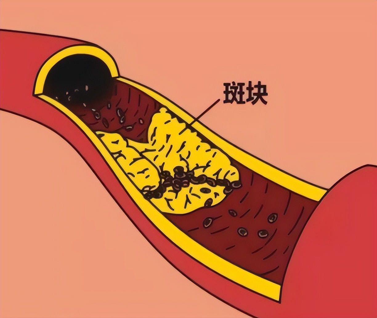 78岁大爷血管内斑块"消失",仅用一年时间,他是如何做到的?