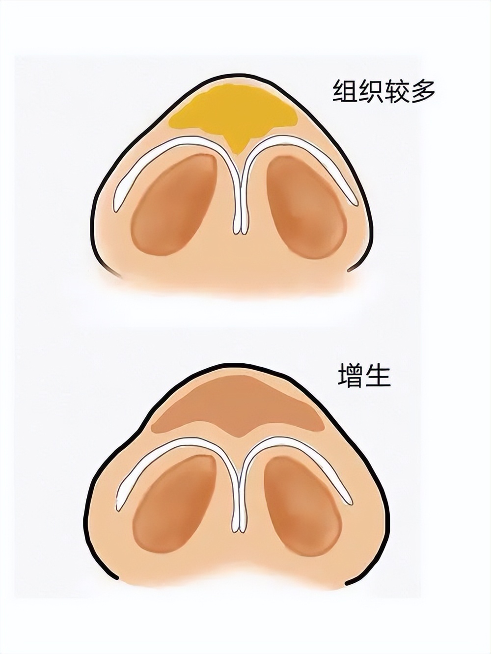 大鼻头能缩小吗，有哪些有效的方法？