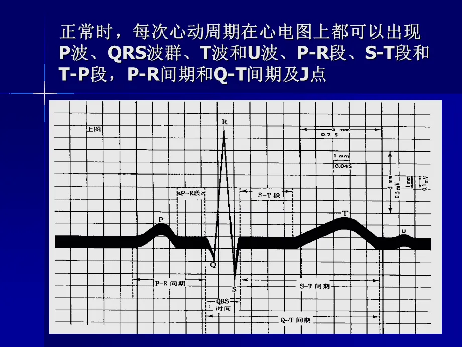 因为心电图只是心脏检查的一个基础检查项目,它只能记录患者当时的心