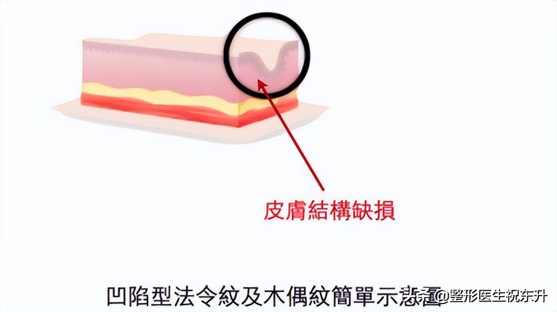 脸上有了法令纹？消除真的不难，这“3个方法”实用又有效