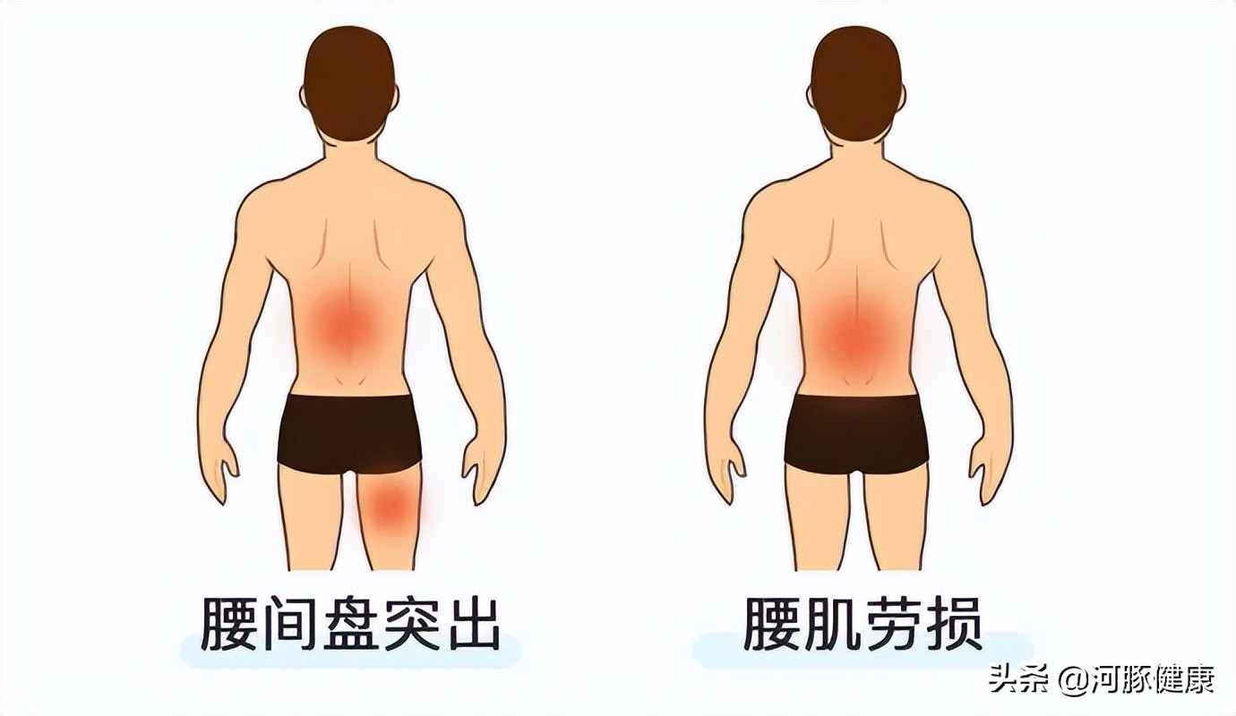 如何快速区分腰椎间盘突出与腰肌劳损