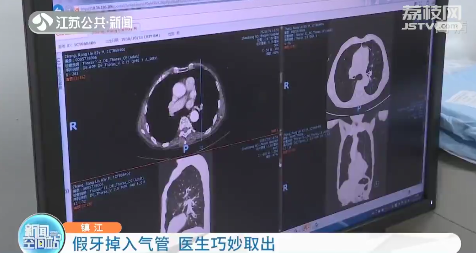 镇江大爷假牙掉入气管 医生巧妙拽出