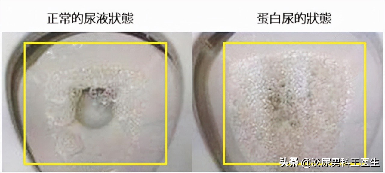 肾好不好，一泡尿就能知晓？若尿液有几种变化，需尽快给肾做检查