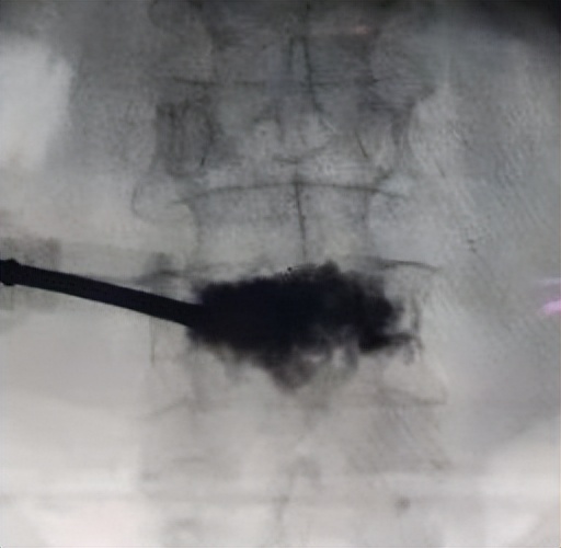 金堂县二医院骨科成功开展县内首例经皮穿刺弯角椎体成形手术