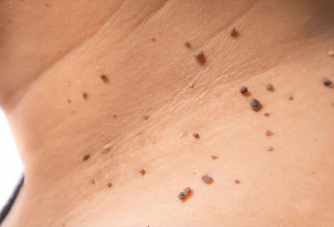 皮赘,又叫作软纤维瘤,常见于中老年人,以女性多见,好发于颈,腋窝,腹股