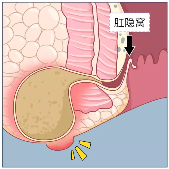 肛门直肠周围脓肿图片图片