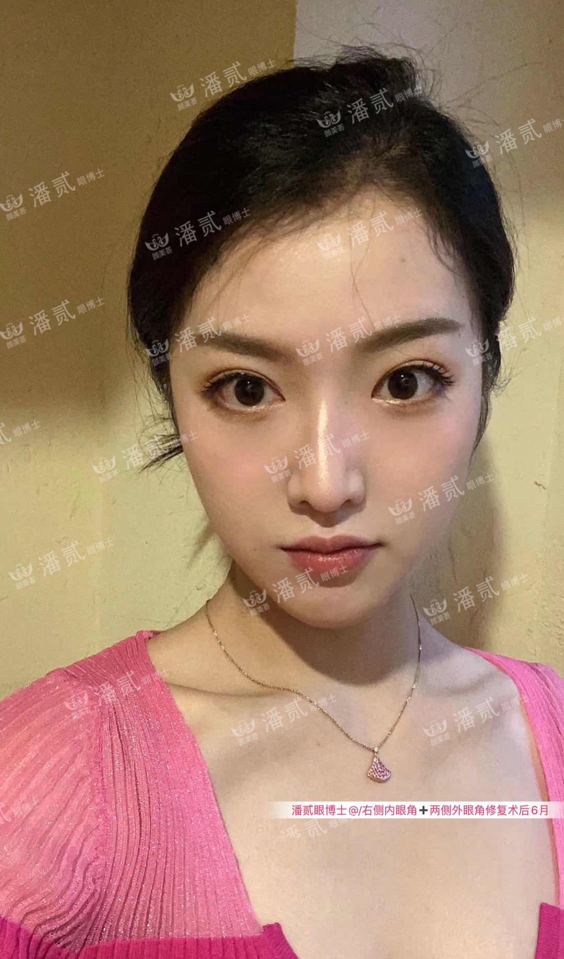 四川女子整容失败：我当初就不应该去开内外眼角，做多了只会变丑
