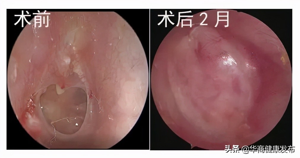 一巴掌下去，耳膜穿孔了？还能治吗？