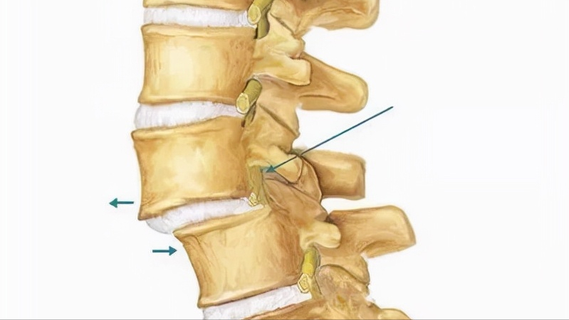 腰腿疼痛时,请不要只想着腰间盘突出,这种情况也不能忽视