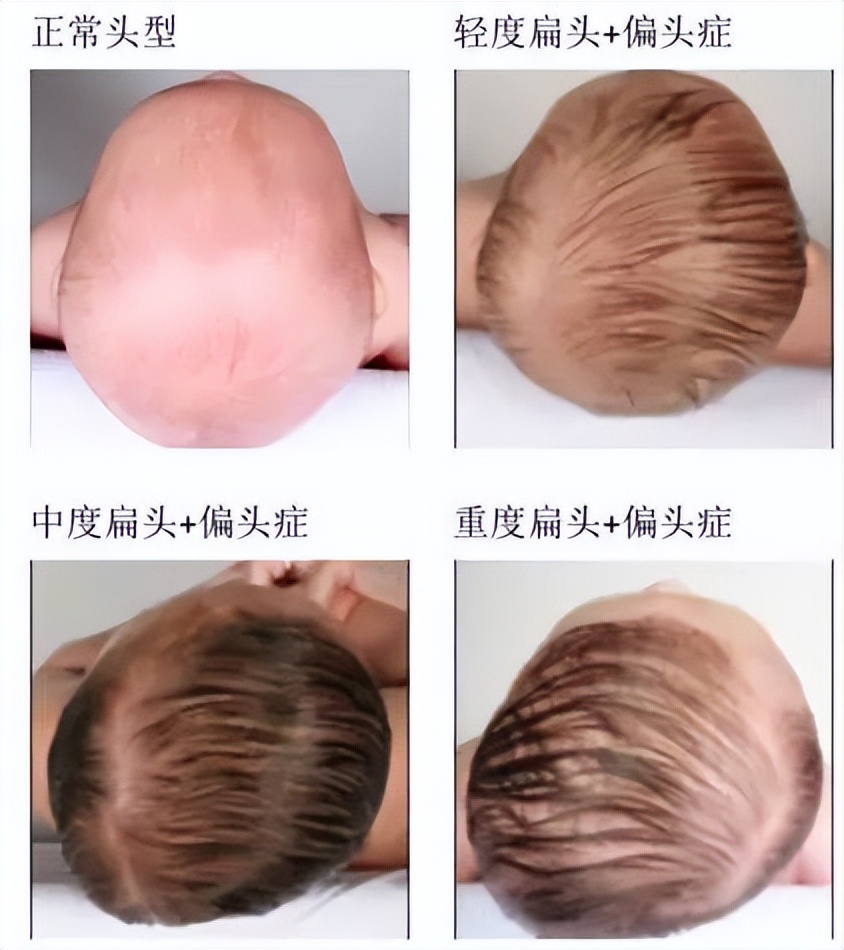 妈妈吐槽宝宝头扁,开启宝宝圆头拯救记