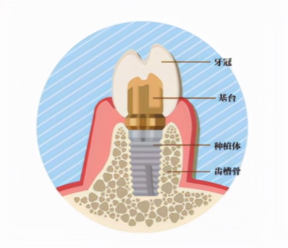成本百元却卖上万，一口假牙可抵一辆宝马，种植牙为什么这么贵？