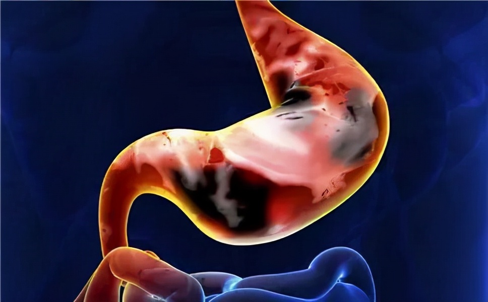 从胃炎到胃癌，需要几年？消化科医生说出实话，不妨查看一下