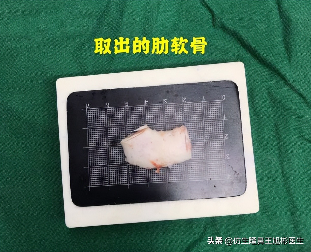 隆鼻整形的风险、危害和后遗症