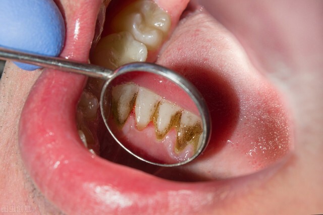 牙龈萎缩不用愁！1步1方法有据可循，轻松还你健康牙口