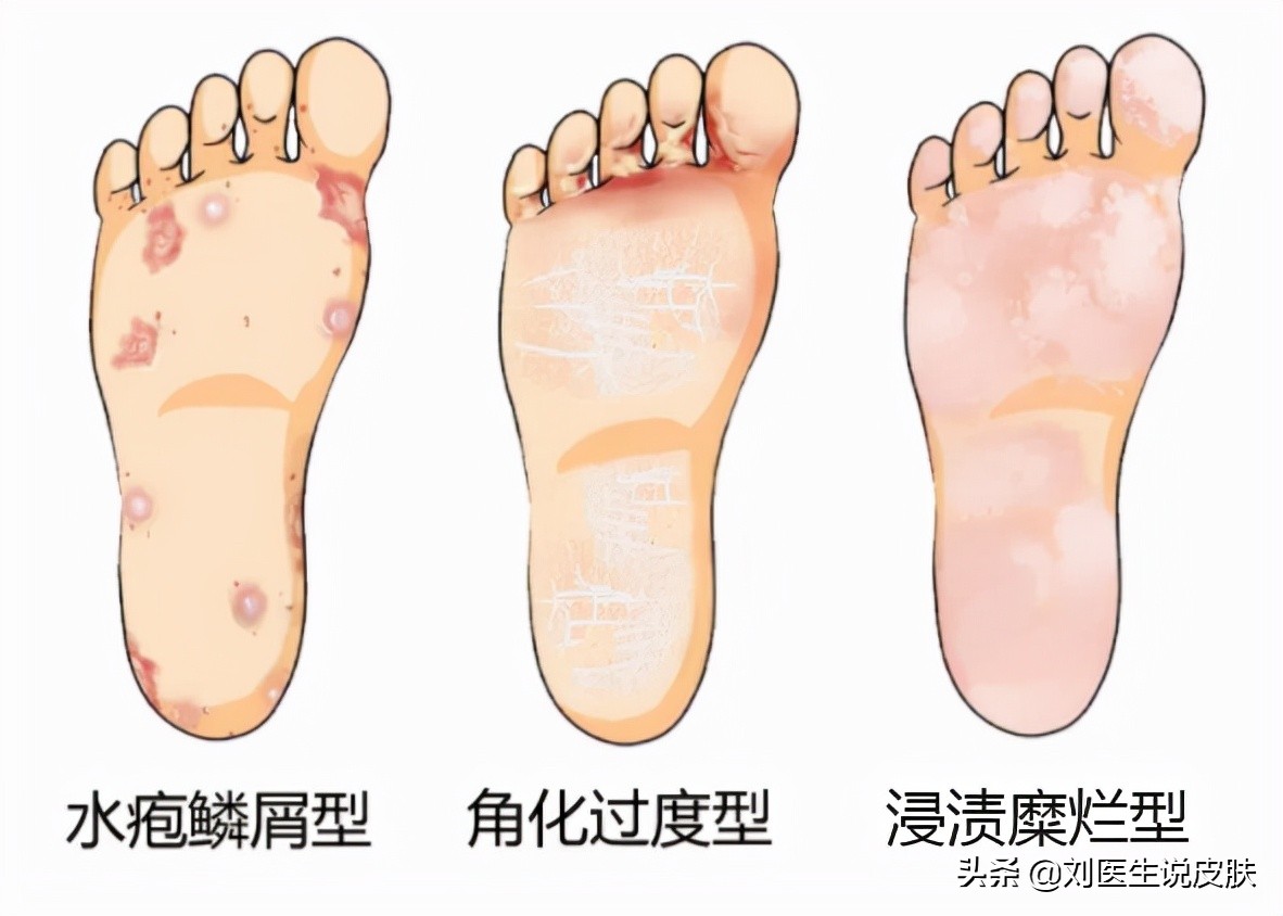 脚气和脚臭是一码事儿吗？全网最全干货，摆脱脚臭、脚痒、脚脱皮