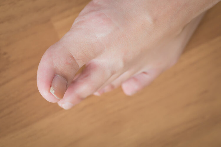 脚趾甲老往肉里钻，一碰还疼？教你3个妙招，预防甲沟炎告别疼痛