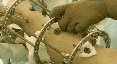 7年前花费了家里16万，只为增高7.2厘米的男孩，如今与后遗症为伴