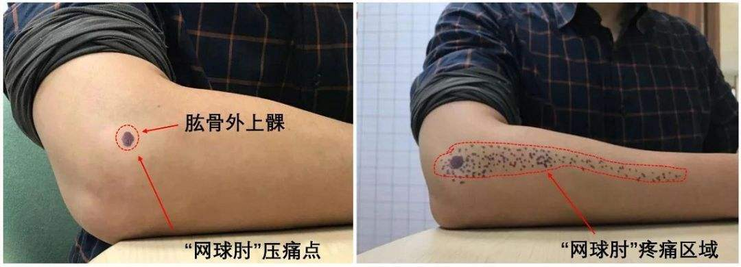 手不能握,胳膊肘外侧疼痛是怎么回事?这几种方法帮助大家缓解