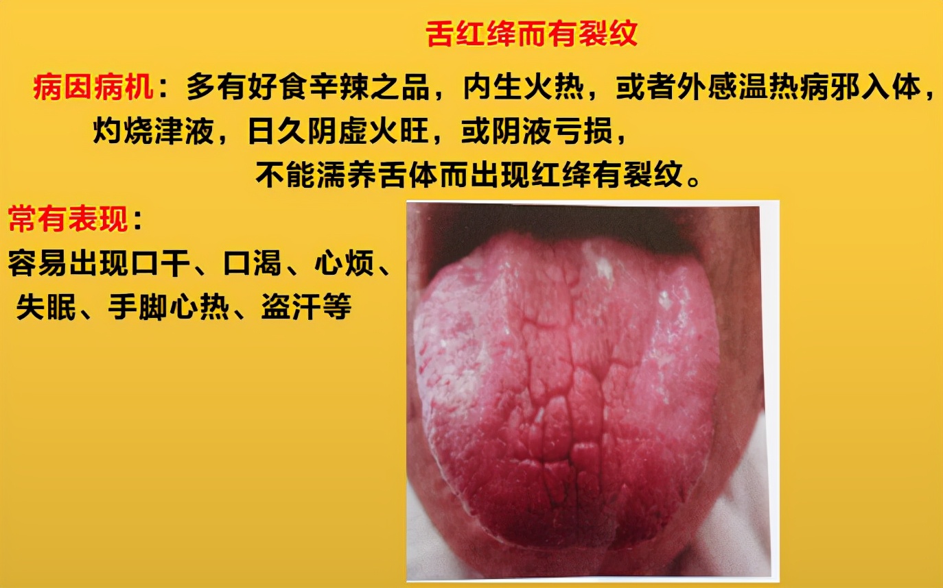 舌头边缘有齿痕，舌苔中间有裂纹？3种齿痕5种裂纹，你是哪一种？