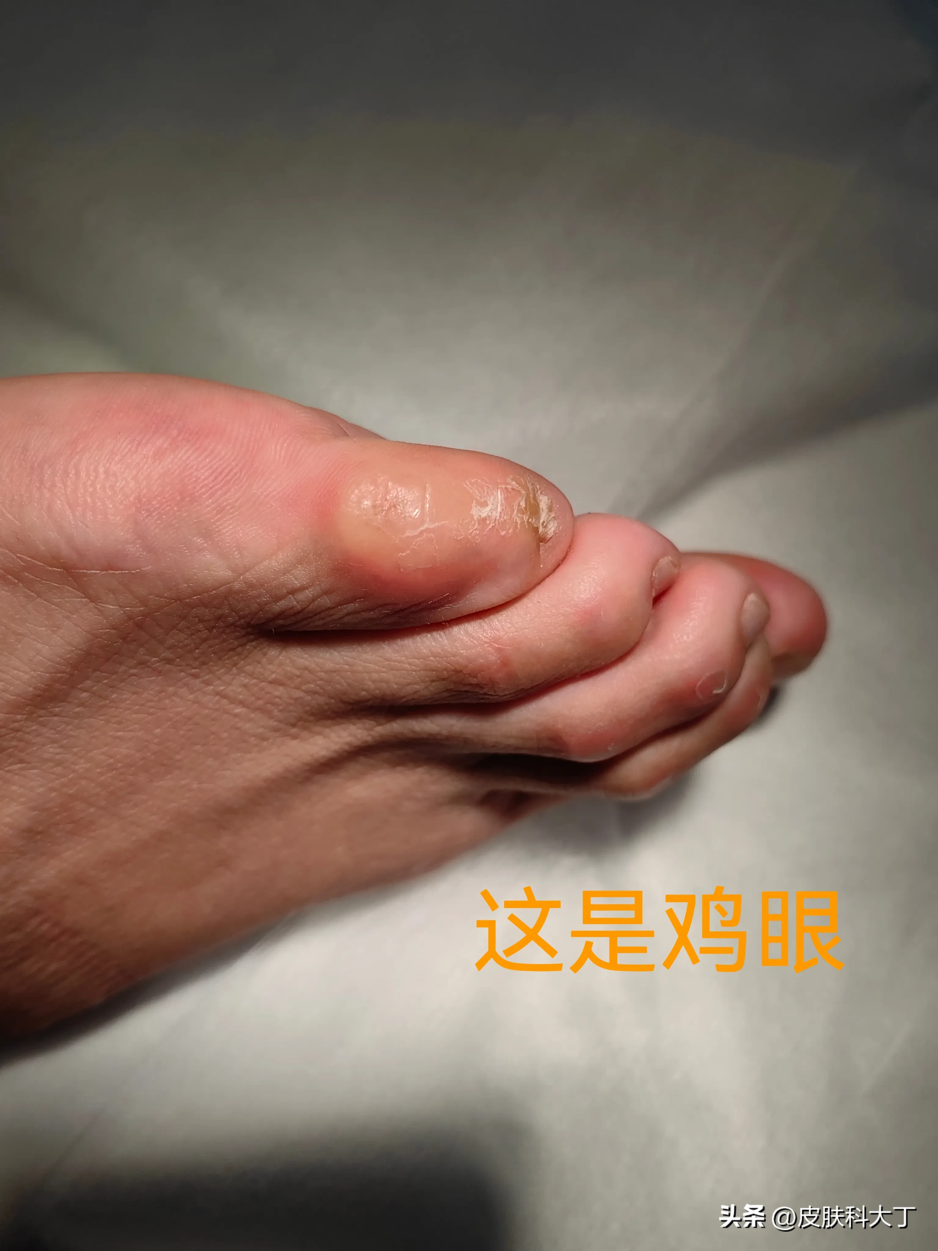我脚上这个鸡眼去修脚店修过几次，之后又反复长出来,走路特别疼，高跟鞋都穿不了