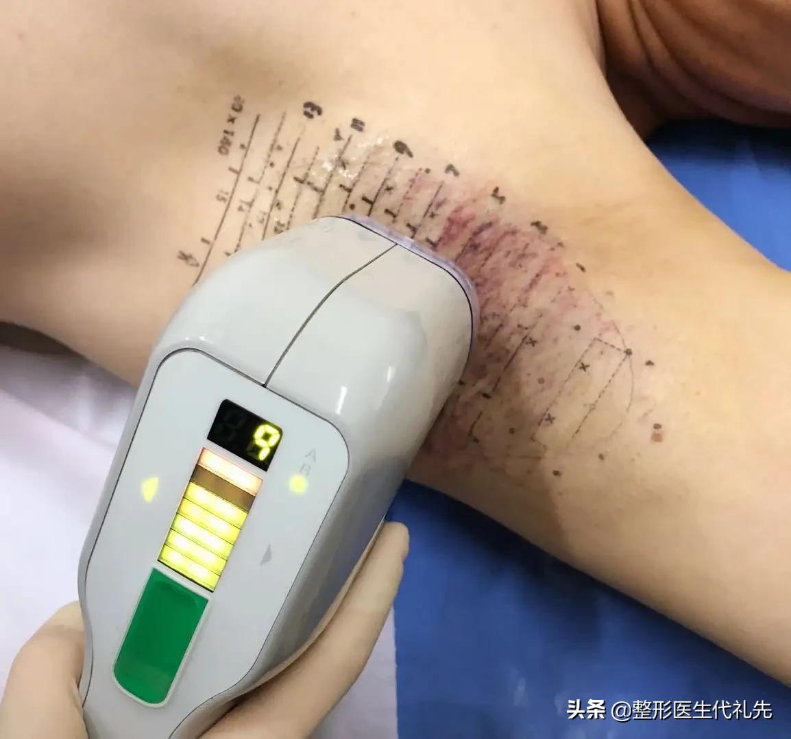腋臭专题｜腋臭用什么办法根除？