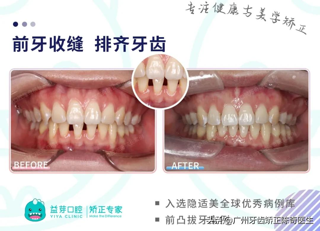 全球优秀案例 | 隐适美拔牙矫正1年半时间解除牙列间隙、改善嘴凸