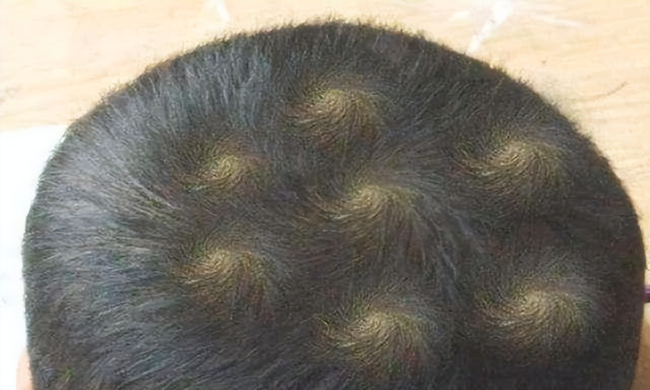 种生理现象,与人格疾病无关,人的头发在南北半球的旋转也没有显著差异