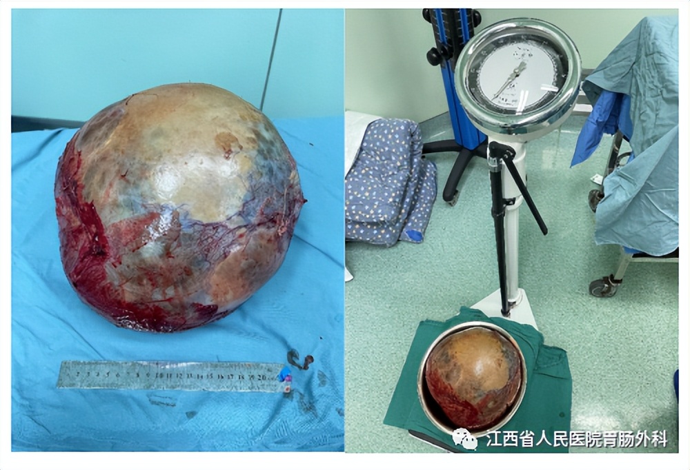 仁医医术| 鲐背老人“拆弹记”