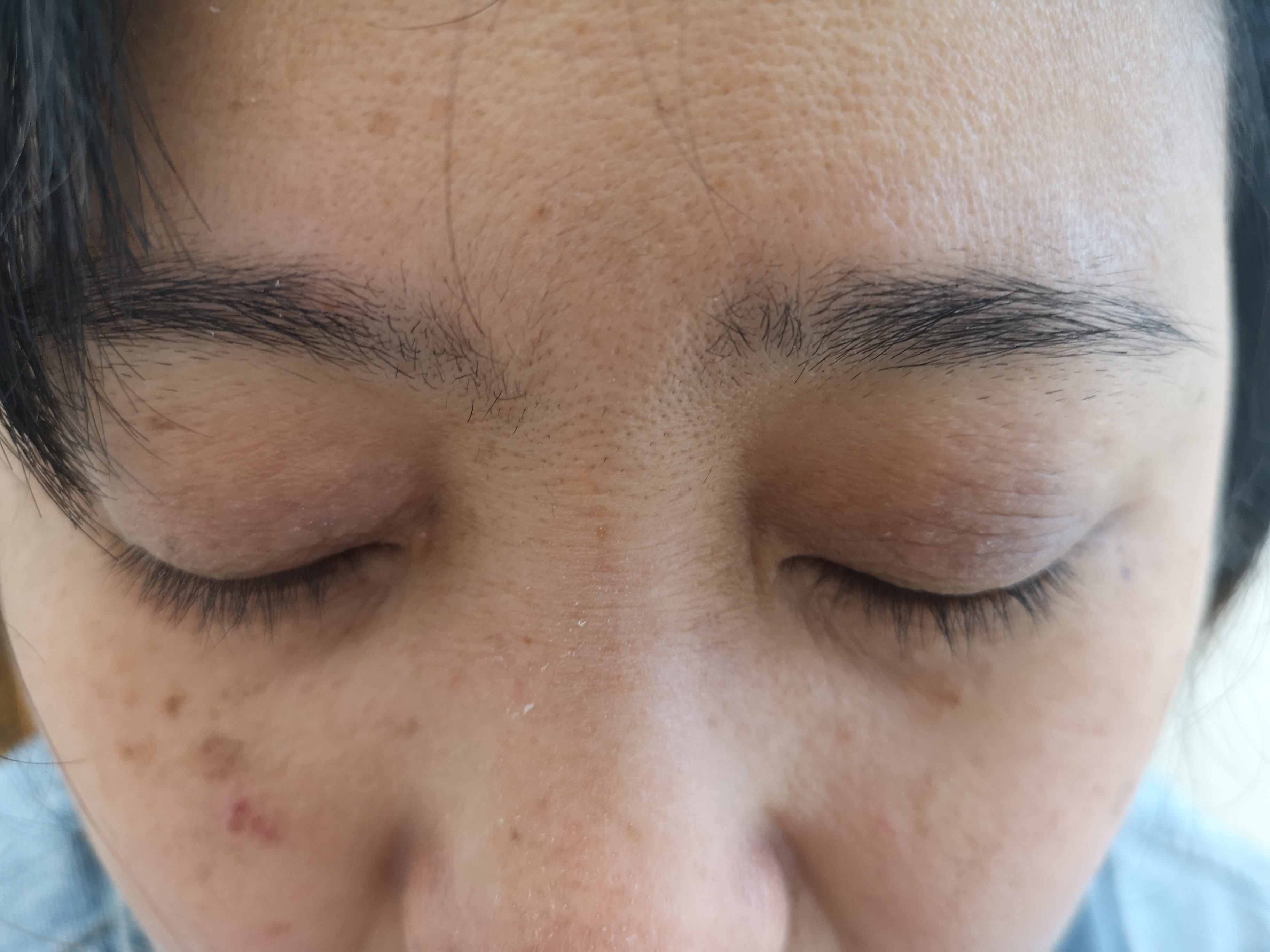 上眼皮神经性皮炎图片(眼睑红肿瘙痒) - 赤虎壹号