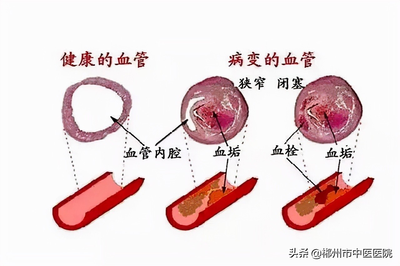 面对血栓！我们该怎么办？