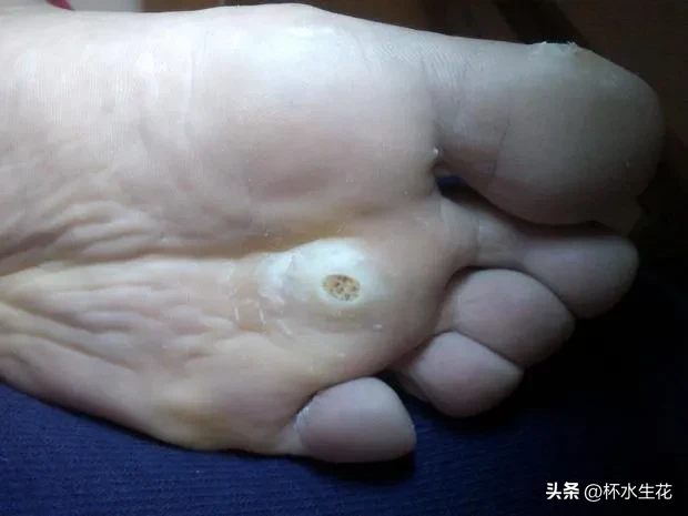 2018年的时候，不知道啥时候开始脚上长的肉刺，一颗一颗的，硬绑绑的