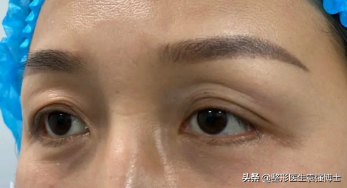 眼皮松弛怎么办(上眼皮耷拉,松弛的2种解决方法,医生说性价比高)