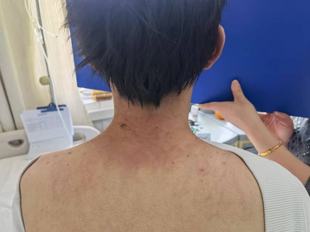 18岁小伙肌肉酸痛无力以为是感冒 就诊后确诊“皮肌炎”
